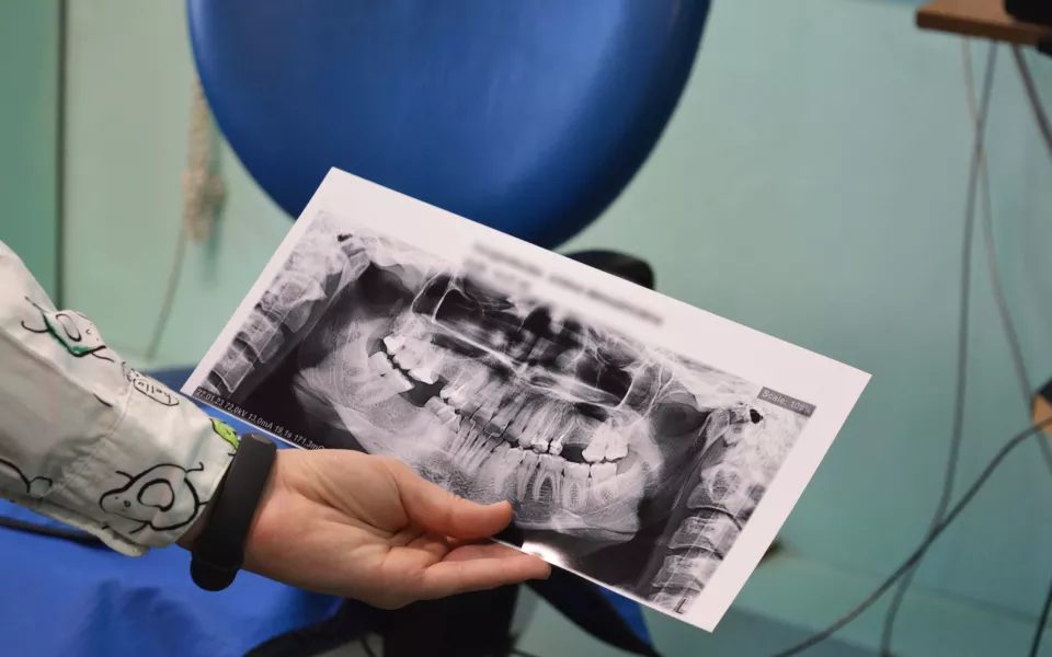 Барнаульские хирурги пересаживают пациентам собственные зубы